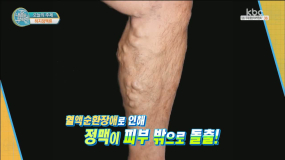 제23회 하지정맥류